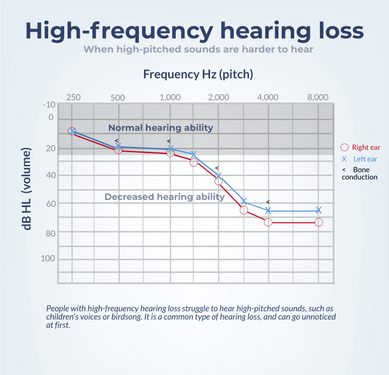 显示高频听力损失的听力图。